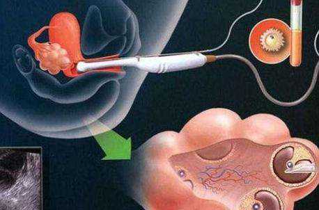 太原供卵代孕试管中心_做试管婴儿到底有多痛苦？